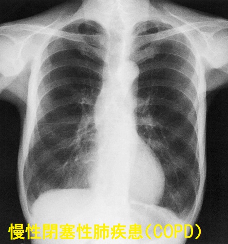 COPD(慢性閉塞性肺疾患) 胸部X線像 COPD(慢性閉塞性肺疾患) 胸部X線像