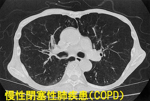 COPD(慢性閉塞性肺疾患) 胸部CT画像 COPD(慢性閉塞性肺疾患) 胸部CT画像