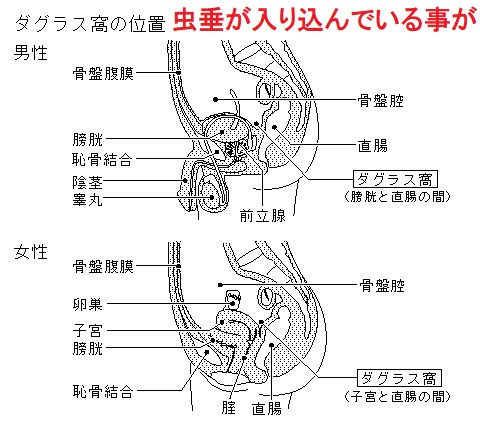 虫垂炎 ダグラス窩 虫垂炎 ダグラス窩