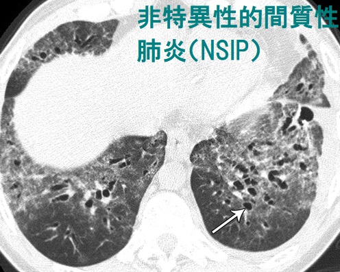 非特異性的間質性肺炎(NSIP)CT画像 非特異性的間質性肺炎(NSIP)CT画像