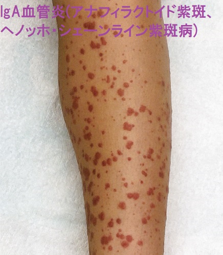 IgA血管炎(アナフィラクトイド紫斑、ヘノッホ・シェーンライン紫斑病) IgA血管炎(アナフィラクトイド紫斑、ヘノッホ・シェーンライン紫斑病)