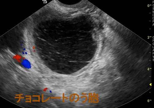 チョコレートのう胞 超音波(エコー)画像 チョコレートのう胞 超音波(エコー)画像