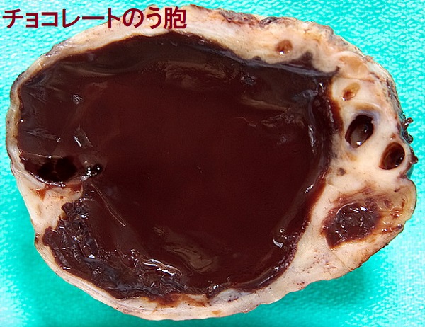 チョコレートのう胞 チョコレートのう胞