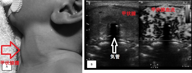 新生児バセドウ病、巨大甲状腺腫による気道狭窄と新生児遷延性肺高血圧 新生児バセドウ病、巨大甲状腺腫による気道狭窄と新生児遷延性肺高血圧