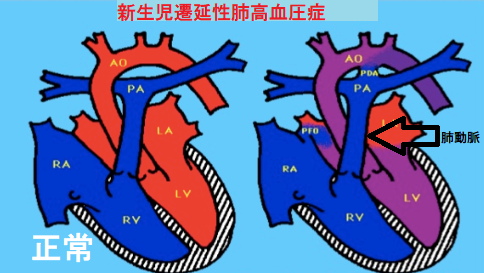 新生児遷延性肺高血圧症 新生児遷延性肺高血圧症