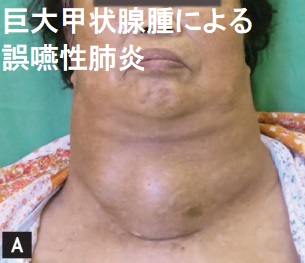 巨大甲状腺腫による誤嚥性肺炎 巨大甲状腺腫による誤嚥性肺炎