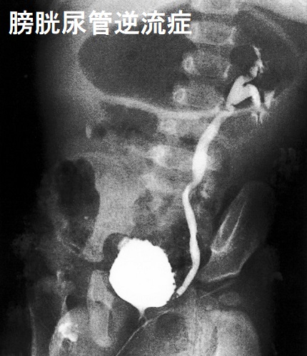 膀胱尿管逆流症 膀胱尿管逆流症