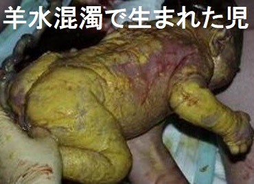 羊水混濁で生まれた児 羊水混濁で生まれた児