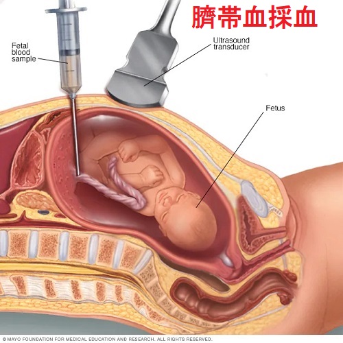 臍帯血採血 臍帯血採血