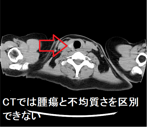 CTでは腫瘍と不均質さを区別できない(CT画像) CTでは腫瘍と不均質さを区別できない(CT画像)