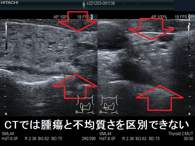 CTでは腫瘍と不均質さを区別できない 超音波(エコー)画像 CTでは腫瘍と不均質さを区別できない 超音波(エコー)画像