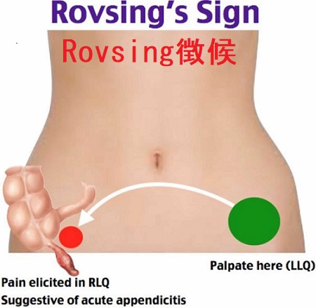 Rovsing徴候 Rovsing徴候