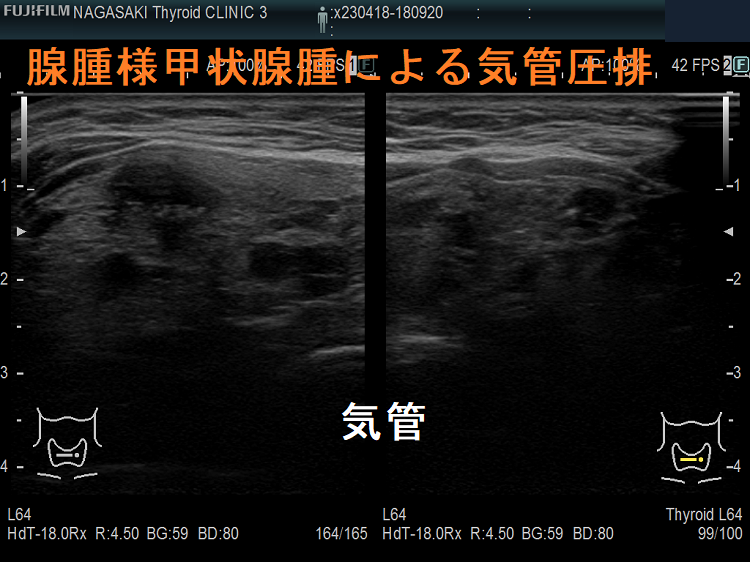 腺腫様甲状腺腫による気管圧排 腺腫様甲状腺腫による気管圧排