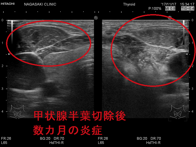 甲状腺半葉切除後 数カ月の炎症 超音波(エコー)画像 甲状腺半葉切除後 数カ月の炎症 超音波(エコー)画像