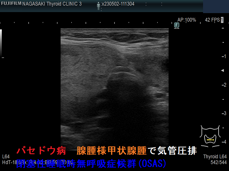 バセドウ病 腺腫様甲状腺腫で気管圧排 閉塞性睡眠時無呼吸症候群(OSAS) バセドウ病 腺腫様甲状腺腫で気管圧排 閉塞性睡眠時無呼吸症候群(OSAS)