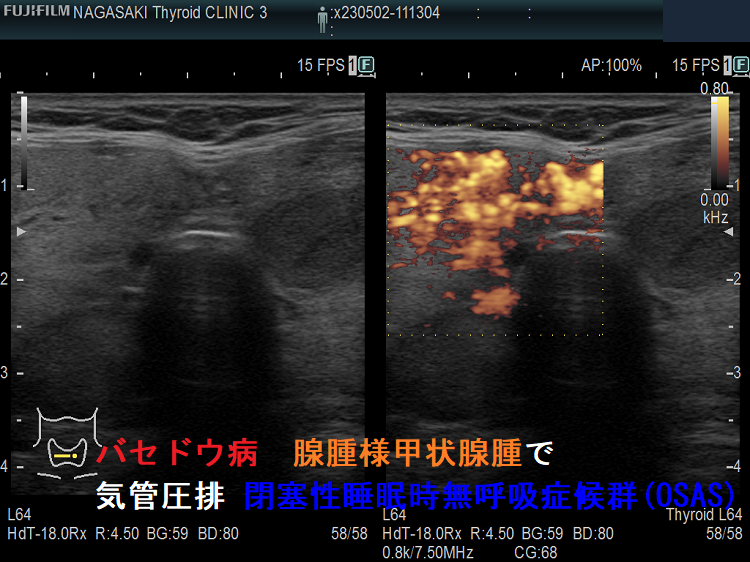 バセドウ病 腺腫様甲状腺腫で気管圧排 閉塞性睡眠時無呼吸症候群(OSAS) ドプラーモード バセドウ病 腺腫様甲状腺腫で気管圧排 閉塞性睡眠時無呼吸症候群(OSAS) ドプラーモード