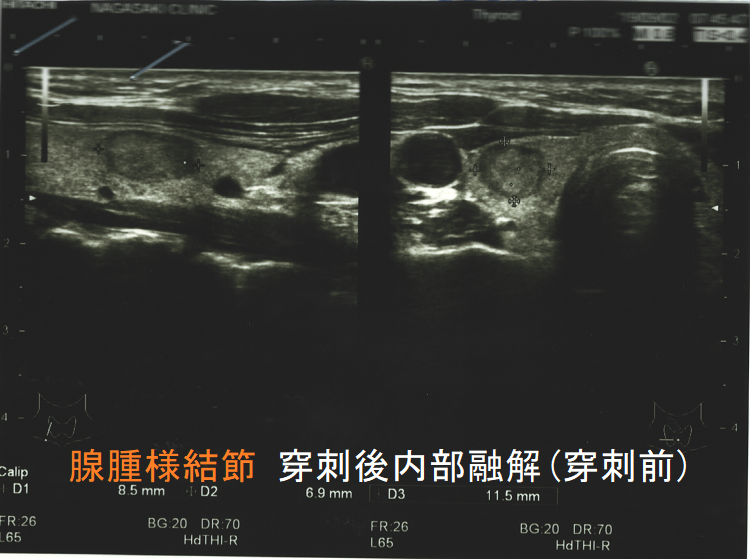 穿刺後内部融解(穿刺細胞診後腫瘍梗塞)超音波(エコー)画像(穿刺前) 穿刺後内部融解(穿刺細胞診後腫瘍梗塞)超音波(エコー)画像(穿刺前)