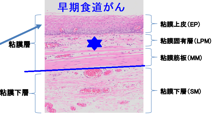 早期食道がん 早期食道がん