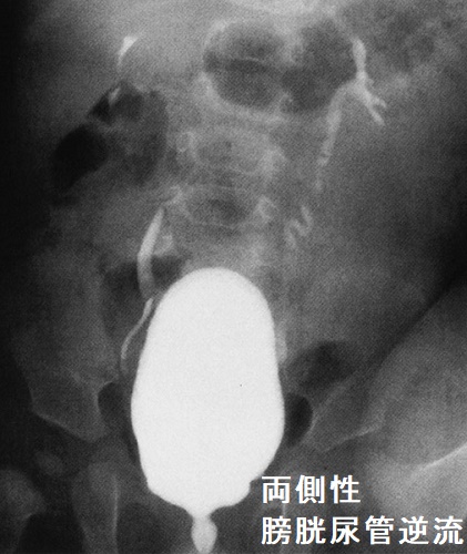 両側性膀胱尿管逆流 両側性膀胱尿管逆流