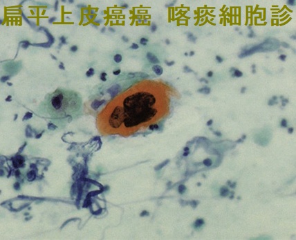喉頭癌(喀痰細胞診のPapanicolaou 染色標本、エオジン・オレンジG 好染) 喉頭癌(喀痰細胞診のPapanicolaou 染色標本、エオジン・オレンジG 好染)