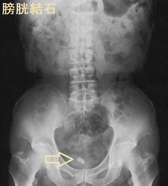 膀胱結石 腹部エックス線写真 膀胱結石 腹部エックス線写真