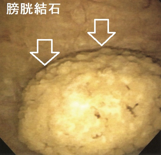 膀胱結石 膀胱鏡像 膀胱結石 膀胱鏡像