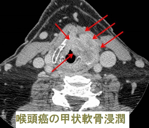 喉頭癌の甲状軟骨浸潤 喉頭癌の甲状軟骨浸潤