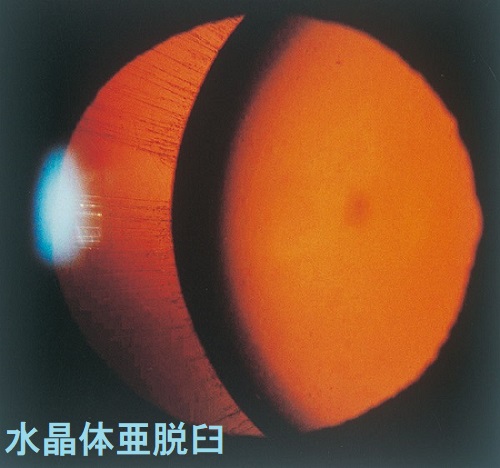 マルファン症候群 水晶体偏位(亜脱臼) マルファン症候群 水晶体偏位(亜脱臼)