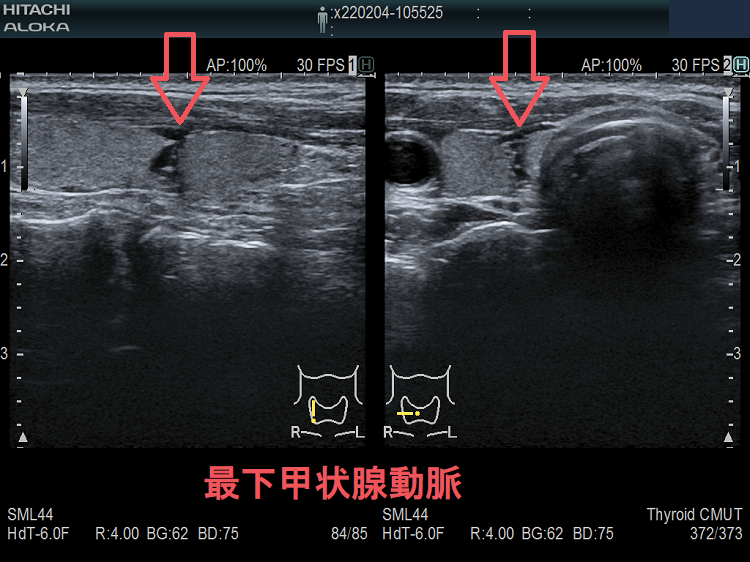 最下甲状腺動脈 超音波(エコー)画像 最下甲状腺動脈 超音波(エコー)画像