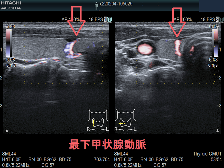 最下甲状腺動脈 超音波(エコー)画像 ドプラー 最下甲状腺動脈 超音波(エコー)画像 ドプラー