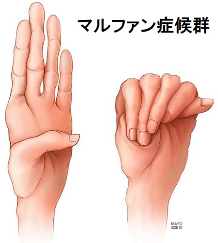 マルファン症候群 マルファン症候群