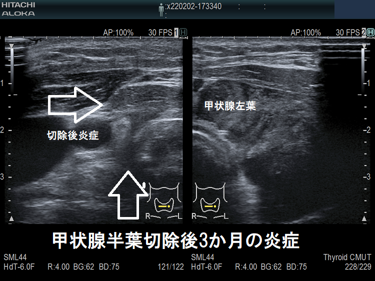 甲状腺半切除後 3カ月の炎症 超音波(エコー)画像 甲状腺半切除後 3カ月の炎症 超音波(エコー)画像
