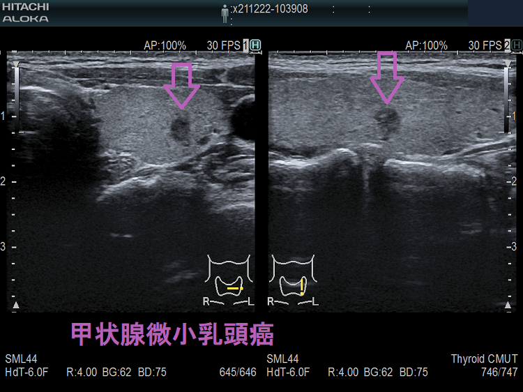 典型的な甲状腺微小乳頭癌 超音波(エコー)画像; 典型的な甲状腺微小乳頭癌 超音波(エコー)画像;