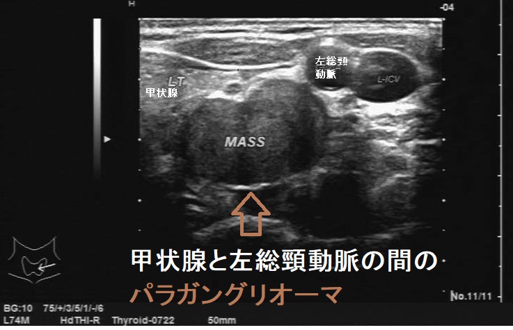 甲状腺と左総頸動脈の間のパラガングリオーマ 超音波(エコー)画像 甲状腺と左総頸動脈の間のパラガングリオーマ 超音波(エコー)画像