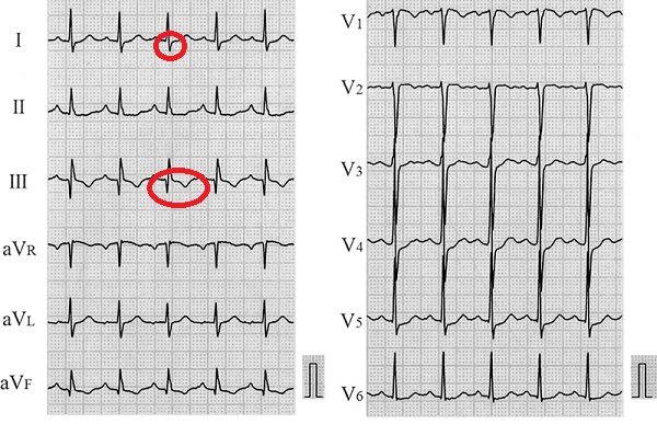 肺血栓塞栓症 心電図 肺血栓塞栓症 心電図