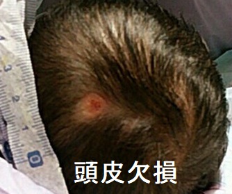 頭皮欠損 頭皮欠損