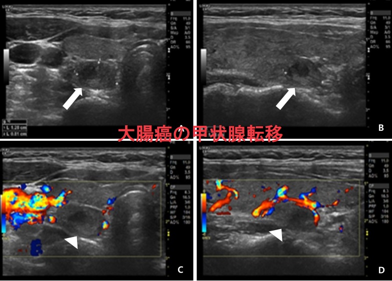 大腸癌の甲状腺転移 超音波(エコー)画像 大腸癌の甲状腺転移 超音波(エコー)画像