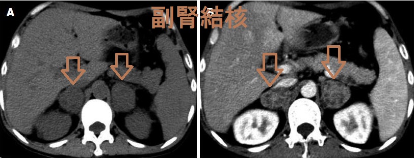 副腎結核 初期 CT画像 副腎結核 初期 CT画像