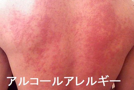 アルコールアレルギー アルコールアレルギー
