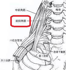 甲状腺癌全摘出後リンパ節再発ではなく前斜角筋 甲状腺癌全摘出後リンパ節再発ではなく前斜角筋