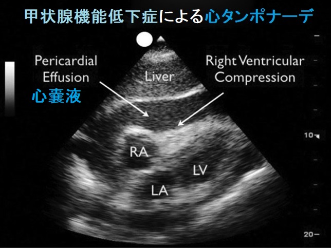 甲状腺と心のう液貯留・心タンポナーデ 甲状腺と心のう液貯留・心タンポナーデ