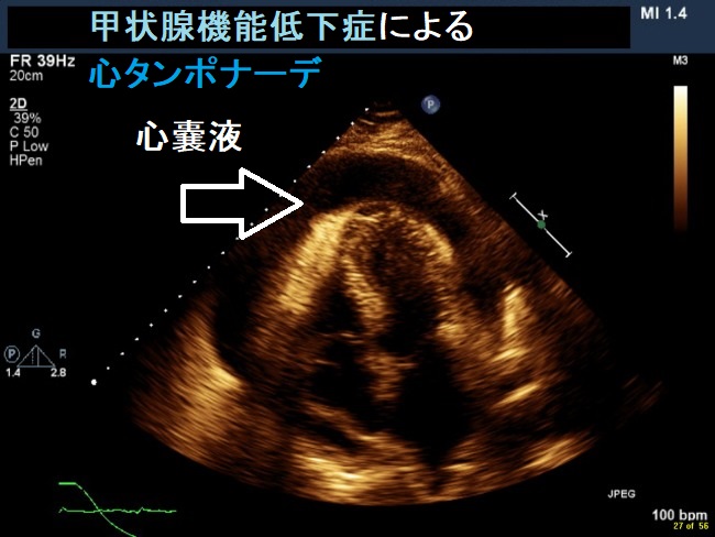 甲状腺機能低下症による心タンポナーデ 甲状腺機能低下症による心タンポナーデ