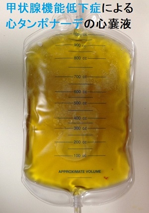 甲状腺機能低下症による心タンポナーデで採取された心嚢穿刺液 甲状腺機能低下症による心タンポナーデで採取された心嚢穿刺液