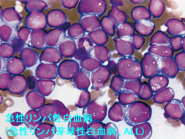 急性リンパ性白血病(急性リンパ芽球性白血病、ALL) 急性リンパ性白血病(急性リンパ芽球性白血病、ALL)