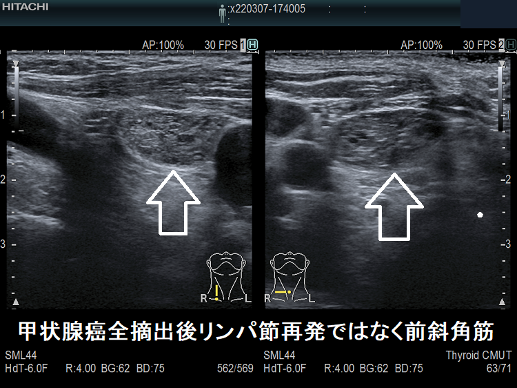 甲状腺癌全摘出後リンパ節再発ではなく前斜角筋 超音波(エコー)画像 甲状腺癌全摘出後リンパ節再発ではなく前斜角筋 超音波(エコー)画像