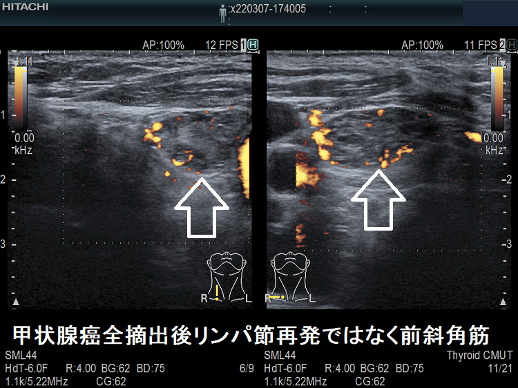 甲状腺癌全摘出後リンパ節再発ではなく前斜角筋 超音波(エコー)画像 ドプラーモード 甲状腺癌全摘出後リンパ節再発ではなく前斜角筋 超音波(エコー)画像 ドプラーモード