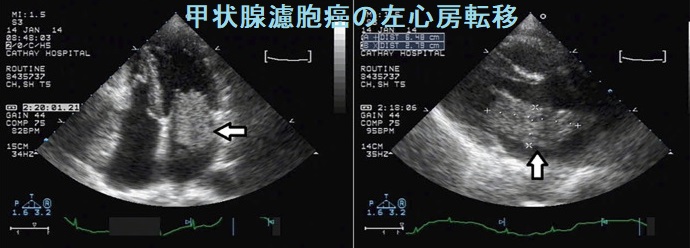 甲状腺濾胞癌の左心房転移 甲状腺濾胞癌の左心房転移