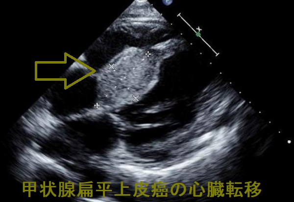 甲状腺扁平上皮癌の心臓転移 甲状腺扁平上皮癌の心臓転移