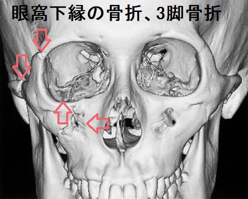 眼窩下縁の骨折、3脚骨折 眼窩下縁の骨折、3脚骨折