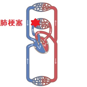 肺血栓塞栓症(肺梗塞) 肺血栓塞栓症(肺梗塞)